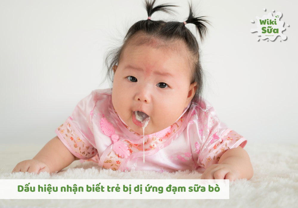 Dấu hiêụ nhận biết trẻ dị ứng sữa đạm bò